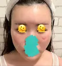 糸リフト / クマ治療 / 脂肪吸引（顔） / 脂肪注入（額） / ヒアルロン酸注入（あご） / ボトックス（エラ・小顔） / 脂肪注入（輪郭） / ボトックス（額） X CLINIC 福岡天神院 DAY 14 サムネイル用