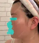 糸リフト / クマ治療 / 脂肪吸引（顔） / 脂肪注入（額） / ヒアルロン酸注入（あご） / ボトックス（エラ・小顔） / 脂肪注入（輪郭） / ボトックス（額） X CLINIC 福岡天神院 DAY 14 サムネイル用