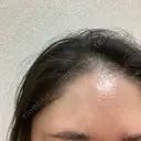 シミ取りレーザー / ピコレーザートーニング（美白・肝斑） Olino美容外科・美容皮膚科 DAY 8 サムネイル用