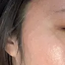 シミ取りレーザー / ピコレーザートーニング（美白・肝斑） Olino美容外科・美容皮膚科 DAY 8 サムネイル用