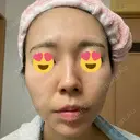 ダーマペン たかだウロクリニック DAY 10 サムネイル用