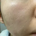 ダーマペン たかだウロクリニック DAY 10 サムネイル用