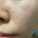 ダーマペン たかだウロクリニック DAY 10 サムネイル用