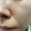 ダーマペン たかだウロクリニック DAY 11 サムネイル用