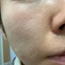 ダーマペン たかだウロクリニック DAY 11 サムネイル用