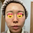 ダーマペン たかだウロクリニック AFTER サムネイル用