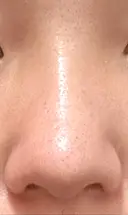 小鼻縮小（切開） / 鼻尖形成（非切開） ASTRA BEAUTY CLINIC DAY 71 サムネイル用