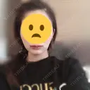 ルフォー+ssro（両あご) / 口角挙上 / ヒアルロン酸注入（唇） / ボトックス（口角） / その他（口元） HB整形外科 DAY 4 サムネイル用