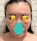 糸リフト / クマ治療 / 脂肪吸引（顔） / 脂肪注入（額） / ヒアルロン酸注入（あご） / ボトックス（エラ・小顔） / 脂肪注入（輪郭） / ボトックス（額） X CLINIC 福岡天神院 DAY 3 サムネイル用