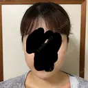 ボトックス（エラ・小顔） 湘南美容クリニック 名古屋栄院 DAY 2 サムネイル用