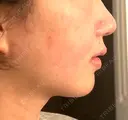 バッカルファット除去 / 脂肪吸引（顔） / ジョールファット除去 WOM CLINIC GINZA （ワム クリニック ギンザ） DAY 106 サムネイル用