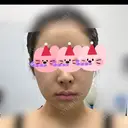 骨切り（あご） / 骨削り（エラ） / 骨削り（頬） リラ・クラニオフェイシャル・クリニック DAY 292 サムネイル用