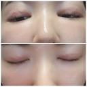 二重埋没 アロマ美容外科クリニック DAY 14 サムネイル用