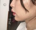 ヒアルロン酸注入（あご） 吉祥寺アイビークリニック DAY 6 サムネイル用