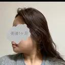 骨切り（あご） / 骨削り（エラ） / 骨削り（頬） リラ・クラニオフェイシャル・クリニック DAY 33 サムネイル用