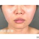 糸リフト アリエル美容クリニック 郡山院 DAY 0 サムネイル用