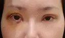二重切開 / 目頭切開 / 眼瞼下垂（切開） / 目元修正 聖心美容クリニック 札幌院 DAY 4 サムネイル用