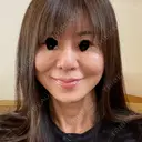 隆鼻術 / 軟骨移植 / 鼻尖縮小 エースクリニック 名古屋院 AFTER サムネイル用