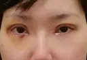 二重切開 / 目頭切開 / 眼瞼下垂（切開） / 目元修正 聖心美容クリニック 札幌院 DAY 5 サムネイル用