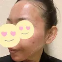 脂肪吸引（顔） / 脂肪注入（肌） / ヒアルロン酸注入（あご） / ボトックス（エラ・小顔） / ダーマペン Mods Clinic（モッズクリニック） 大阪院 DAY 1 サムネイル用