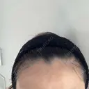 ピーリング（ニキビ・毛穴） 成城スカイファミリークリニック DAY 4 サムネイル用