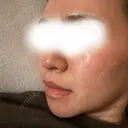 ピーリング（ハリ・ツヤ） アリエル美容クリニック 大宮院 AFTER サムネイル用