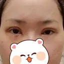 二重切開 / 目頭切開 / 眼瞼下垂（切開） / 目元修正 聖心美容クリニック 札幌院 DAY 7 サムネイル用