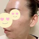 脂肪吸引（顔） / 脂肪注入（肌） / ヒアルロン酸注入（あご） / ボトックス（エラ・小顔） / ダーマペン Mods Clinic（モッズクリニック） 大阪院 DAY 30 サムネイル用