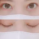 二重埋没 AILE Clinic DAY 60 サムネイル用
