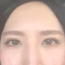 二重埋没 アリエル美容クリニック 郡山院 DAY 4 サムネイル用