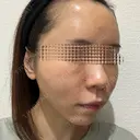 額を丸く / 脂肪注入（肌） / 脂肪注入（額） / 脂肪注入（輪郭） EMMA CLINIC（エマクリニック） DAY 14 サムネイル用