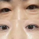 クマ治療 / 脂肪注入（肌） / ボトックス（あご） 銀座みゆき通り美容外科 大阪梅田院 AFTER サムネイル用