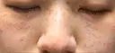 ピコスポット Olino美容外科・美容皮膚科 DAY 1 サムネイル用
