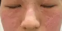 ピコスポット Olino美容外科・美容皮膚科 DAY 0 サムネイル用