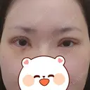 二重切開 / 目頭切開 / 眼瞼下垂（切開） / 目元修正 聖心美容クリニック 札幌院 DAY 9 サムネイル用