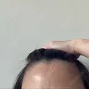 ピーリング（ニキビ・毛穴） 成城スカイファミリークリニック DAY 6 サムネイル用