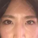 二重埋没 アリエル美容クリニック 郡山院 DAY 5 サムネイル用