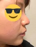 隆鼻術 / 鼻尖形成（切開） / 小鼻縮小（切開） / 鼻修正 グローバルビューティークリニック 東京院 DAY 23 サムネイル用
