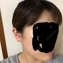 ボトックス（エラ・小顔） 湘南美容クリニック 名古屋栄院 DAY 3 サムネイル用