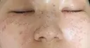 ピコスポット Olino美容外科・美容皮膚科 DAY 2 サムネイル用