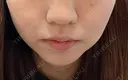 糸リフト / バッカルファット除去 / 脂肪吸引（顔） ブルームクリニック（BLOOM CLINIC） AFTER サムネイル用