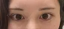 タレ目形成・グラマラスライン（切開） / タレ目形成・グラマラスライン（埋没） リッツ美容外科 東京院 AFTER サムネイル用