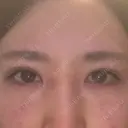 二重埋没 アリエル美容クリニック 郡山院 DAY 7 サムネイル用