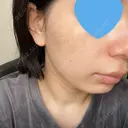 光治療（フォトフェイシャルなど） 椿クリニック 名古屋院 DAY 2 サムネイル用