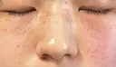 ピコスポット Olino美容外科・美容皮膚科 DAY 4 サムネイル用