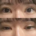 二重切開 / 目頭切開 聖心美容クリニック 札幌院 DAY 31 サムネイル用