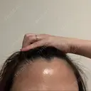 ピーリング（ニキビ・毛穴） 成城スカイファミリークリニック DAY 9 サムネイル用