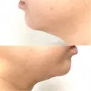 ボトックス（エラ・小顔） / 脂肪溶解注射（顔） / 脂肪溶解注射 渋谷美容外科クリニック 渋谷院 DAY 0 サムネイル用