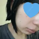 光治療（フォトフェイシャルなど） 椿クリニック 名古屋院 DAY 3 サムネイル用