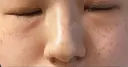 ピコスポット Olino美容外科・美容皮膚科 DAY 6 サムネイル用